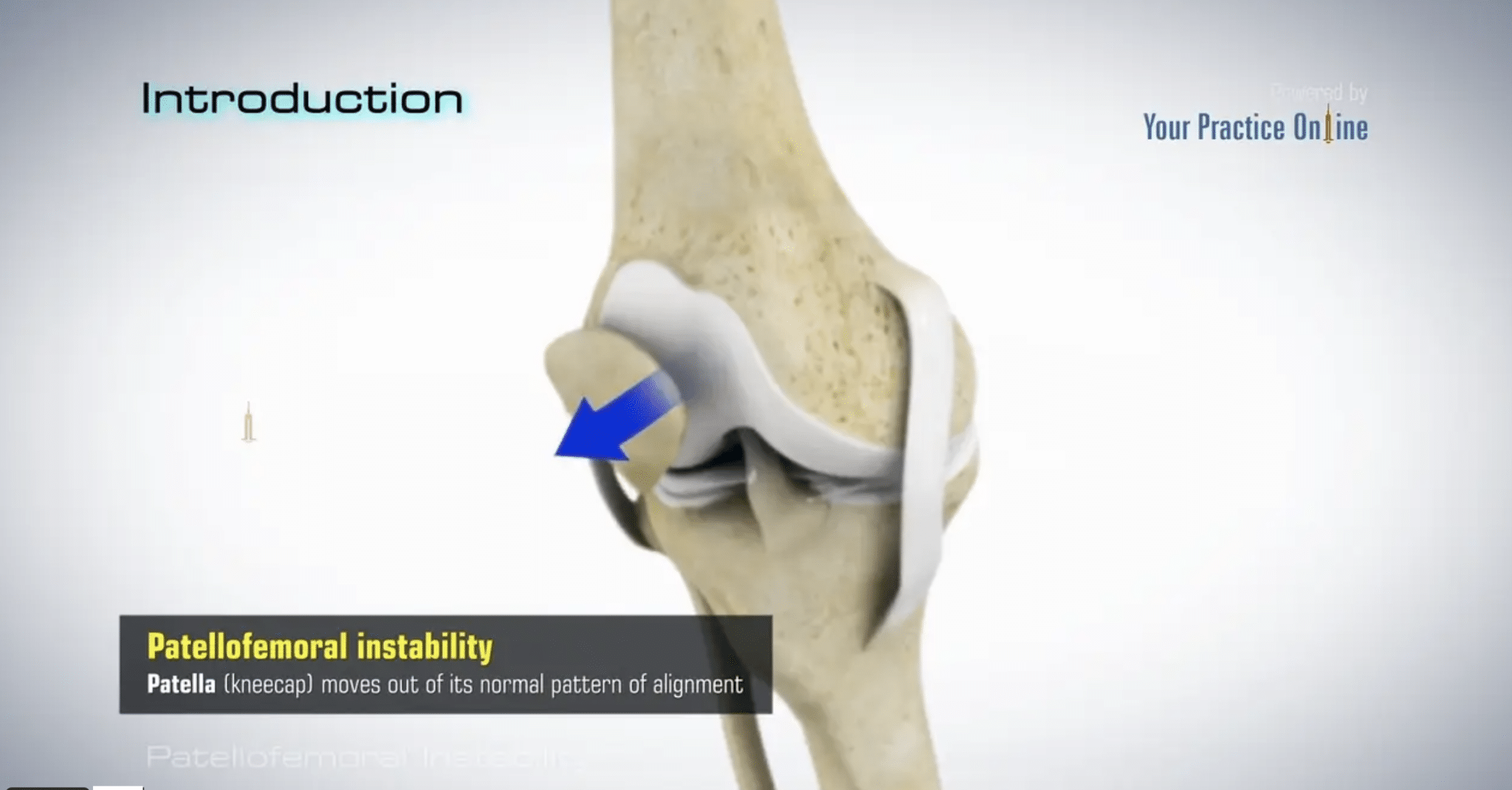 Patient Education - Michigan Knee Institute