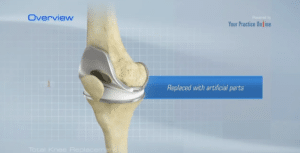 Total Knee Replacement Animation