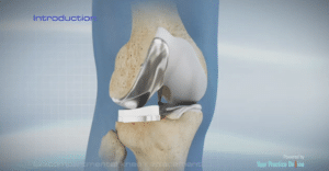 Uni Knee Replacement Animation