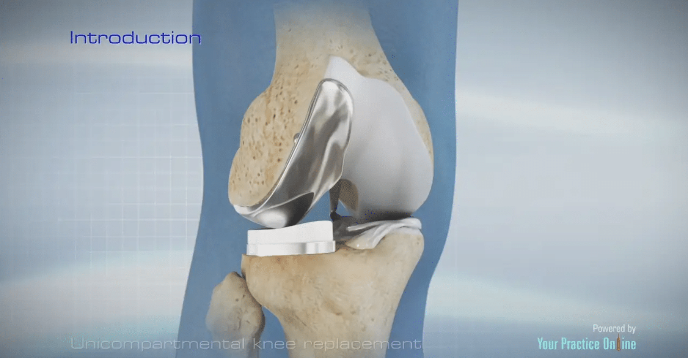 Uni Knee Replacement - Michigan Knee Institute