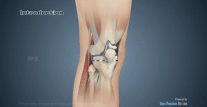 Minimally Invasive Knee Joint Replacement Animation