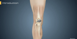 Revision Knee Replacement Animation