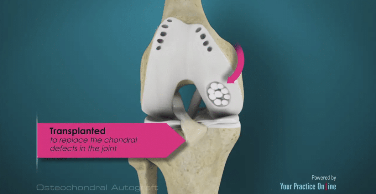 Patient Education - Michigan Knee Institute