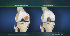 Osteochondral Allograft animation