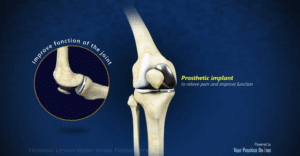 Robotic Unicondylar Knee Replacement animation
