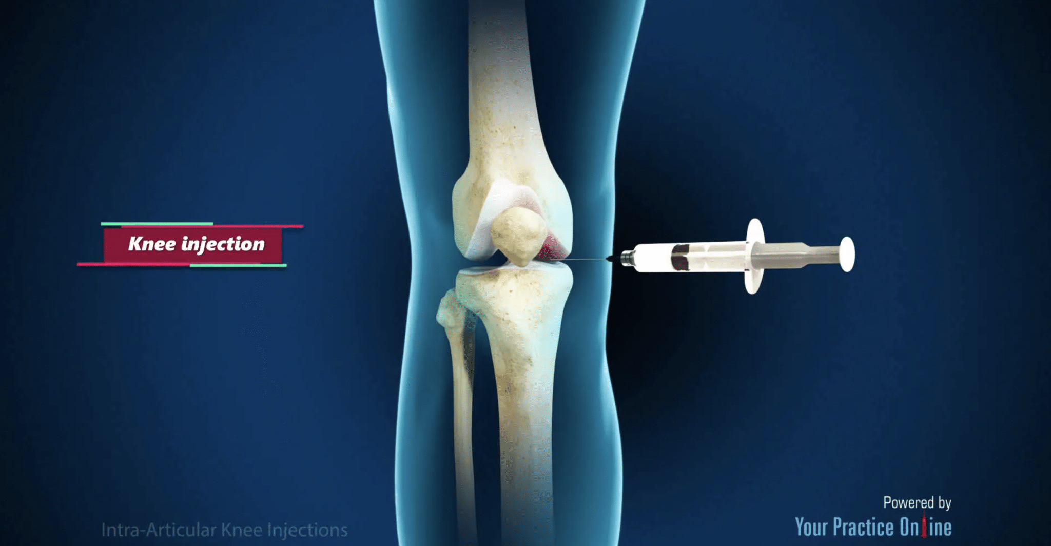 Knee joint. PRP терапия коленного сустава.