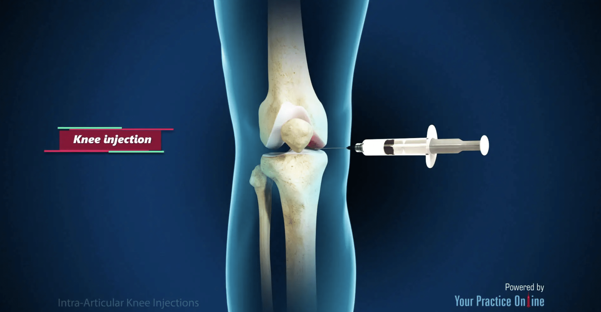 Intra-articular Knee Injections - Michigan Knee Institute