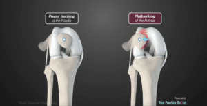 Tibial Tubercle Osteotomy animation