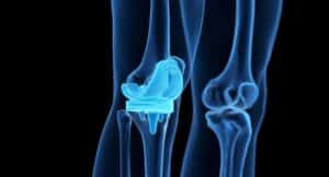 AAOS News: Study Shows Balanced Ligaments Are Key After Total Knee Replacement
